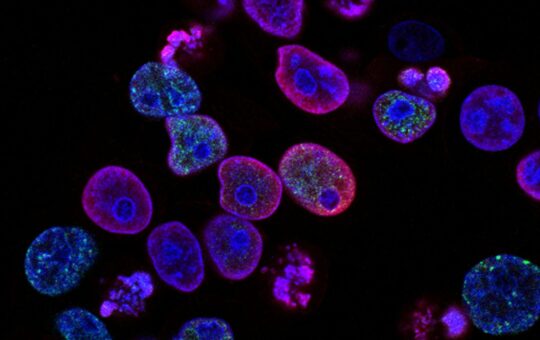 PRISM2 model uses clinical dialogue to interpret pathology slides